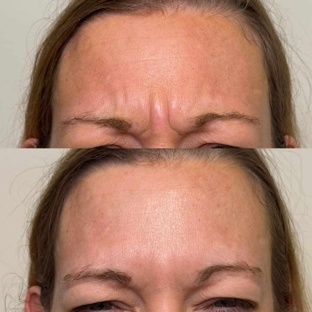 Frown Line Relaxation Before and After