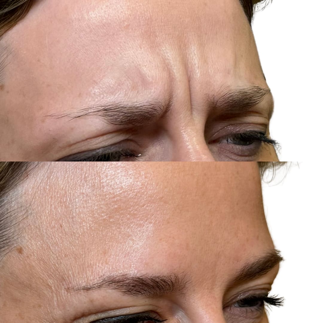 Frown Line Relaxation Before and After