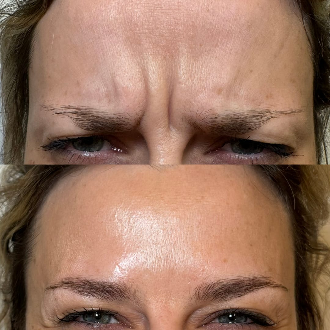 Frown Line Relaxation Before and After