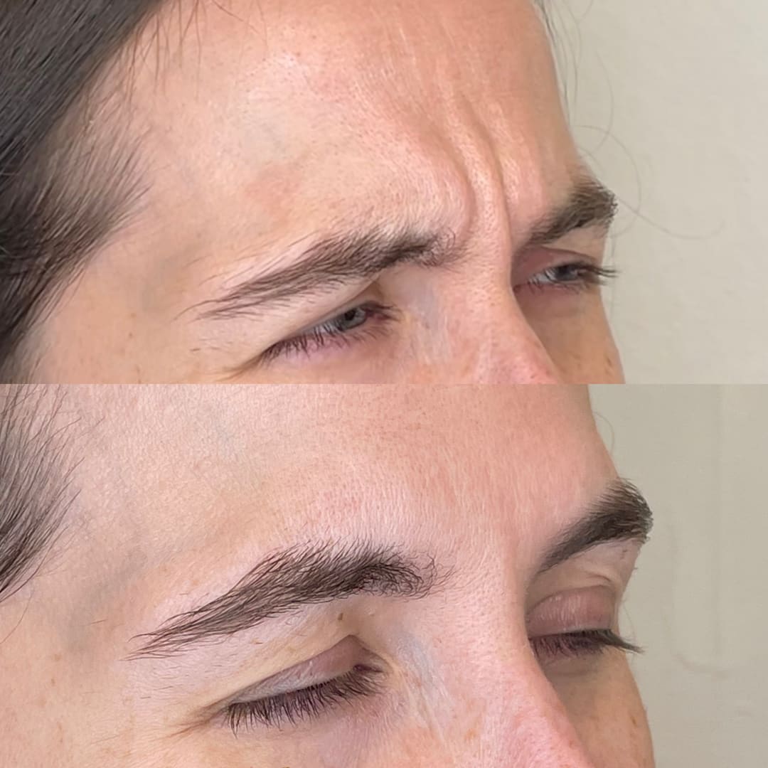 Frown Line Relaxation Before and After