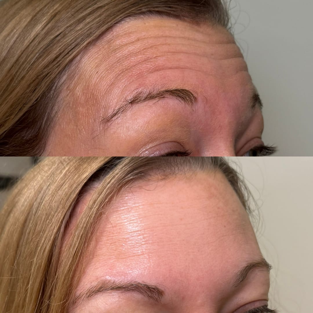 Forehead Line Relaxation Before and After