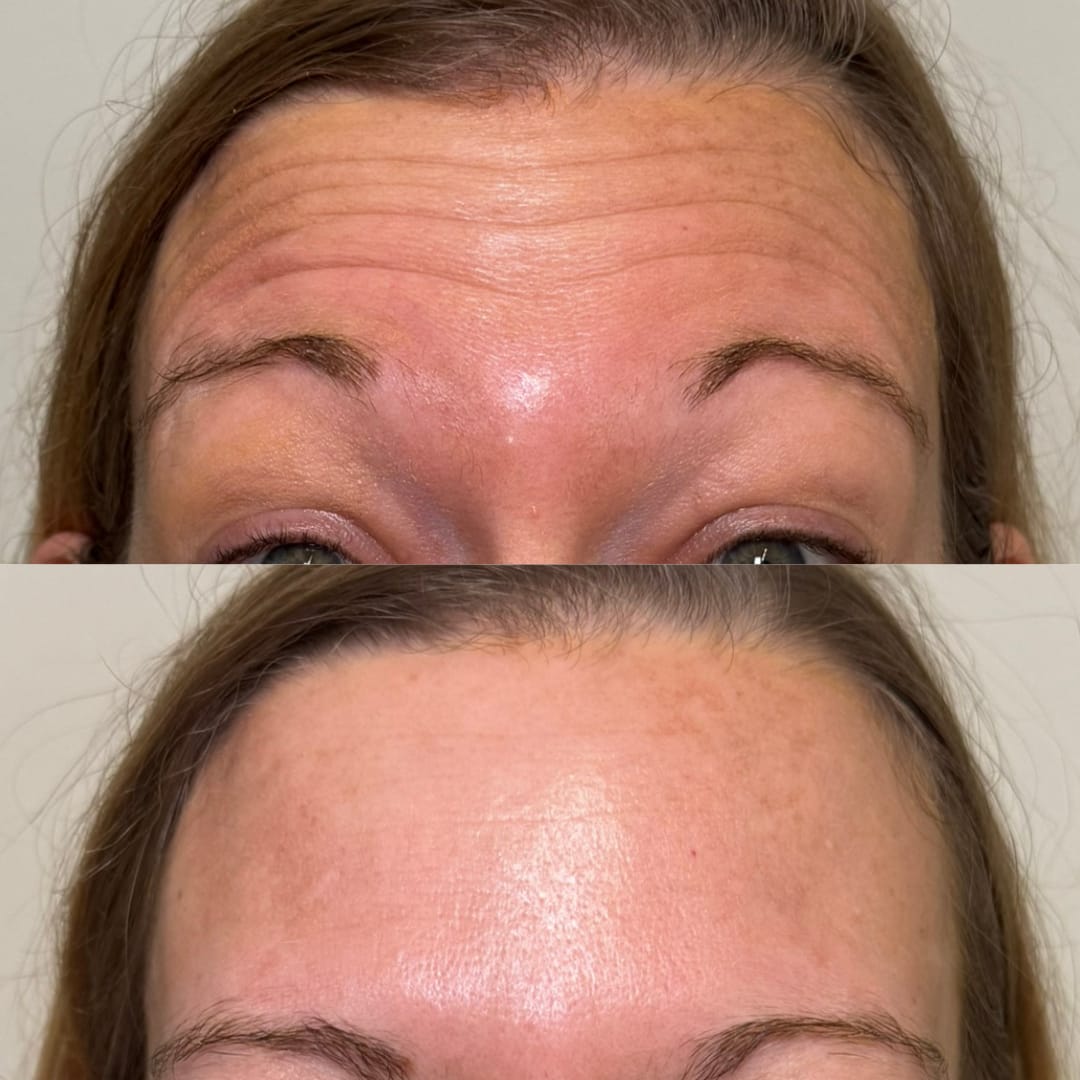 Forehead Line Relaxation Before and After