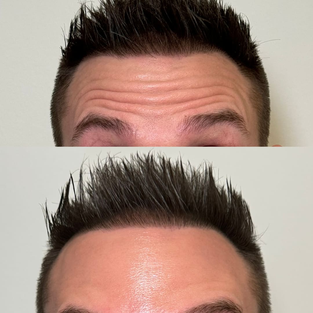 Forehead Line Relaxation Before and After