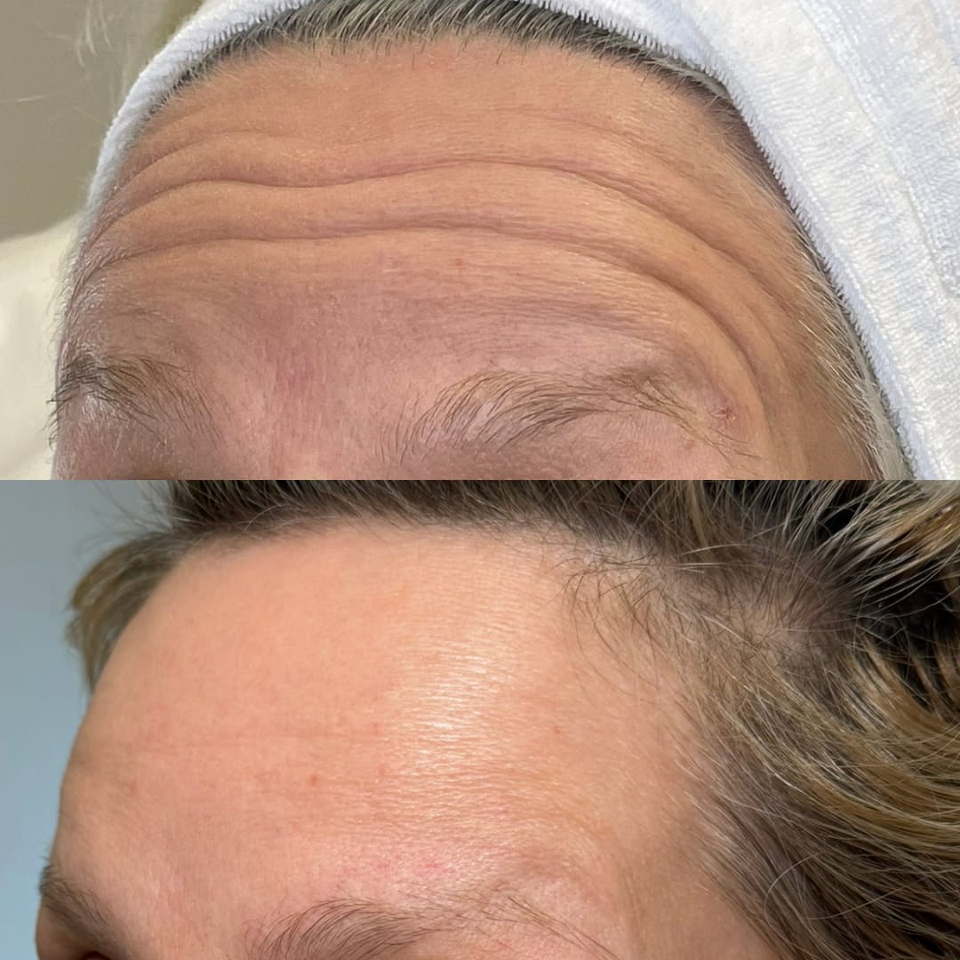 Forehead Line Relaxation Before and After