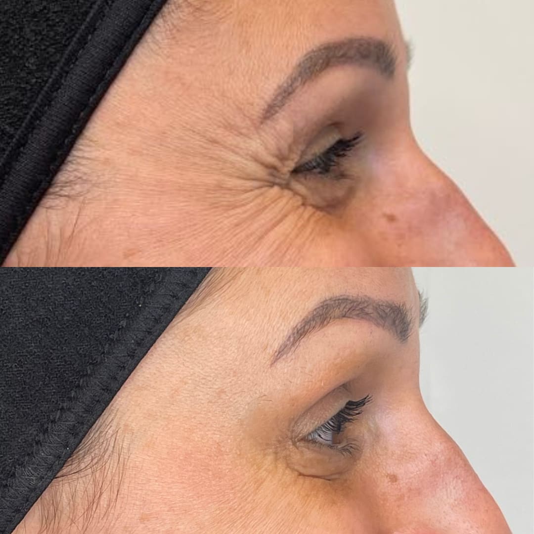 Crows Feet Relaxation Before and After