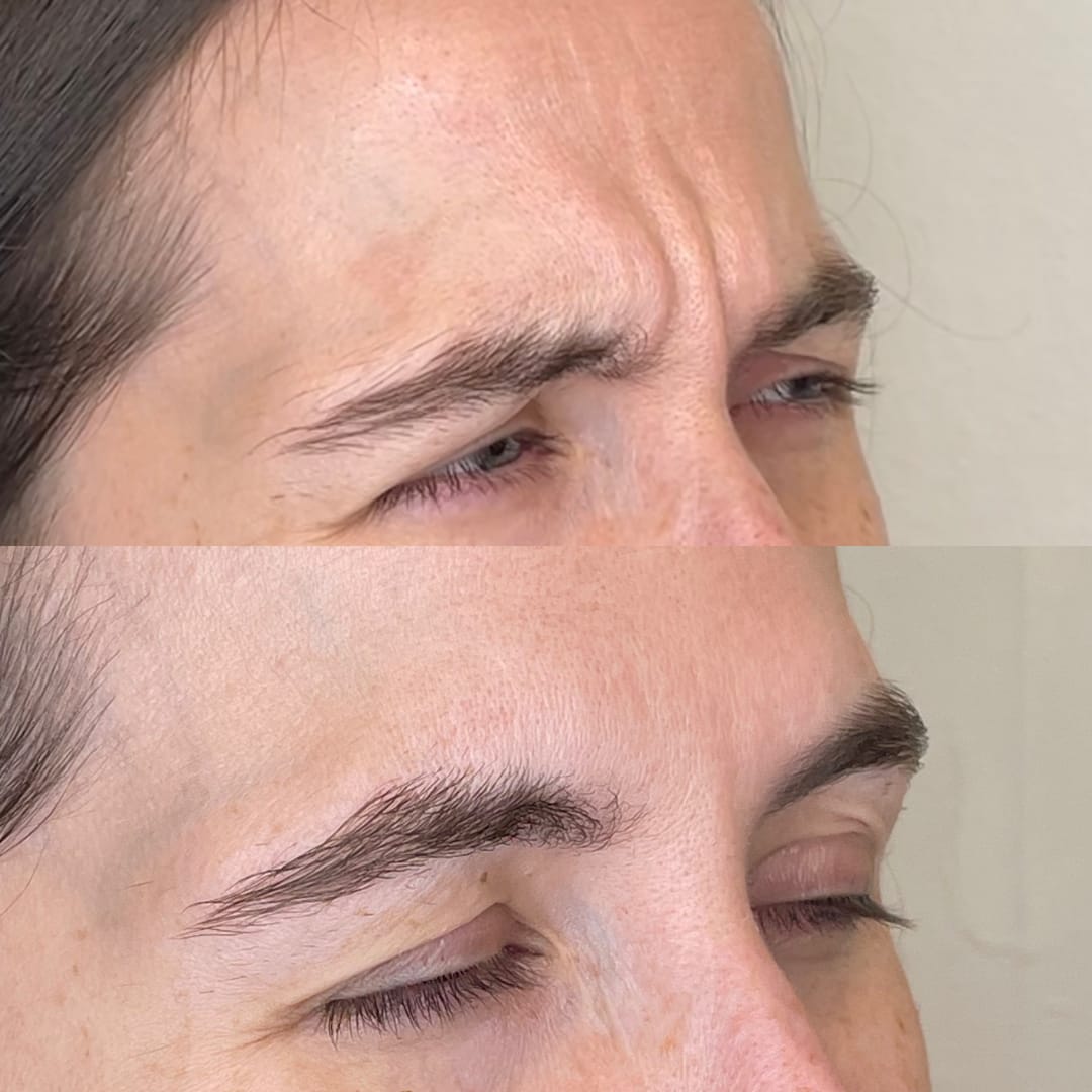 Frown Line Relaxation