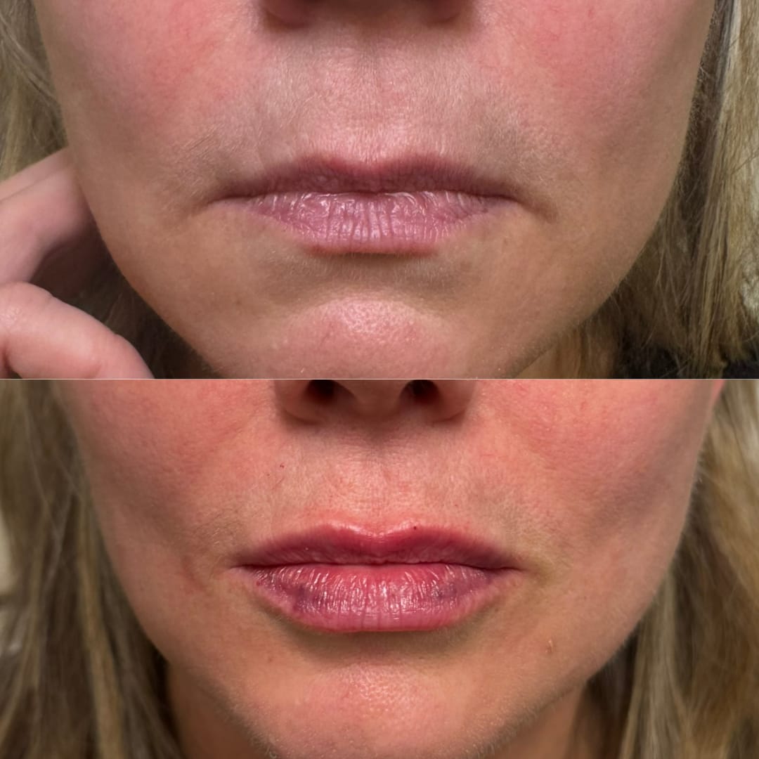 Lip Augmentation