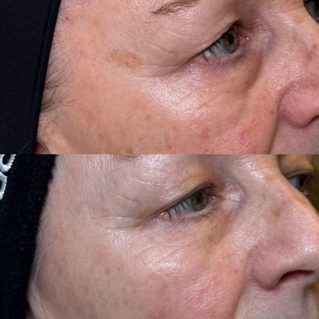 Lumecca IPL