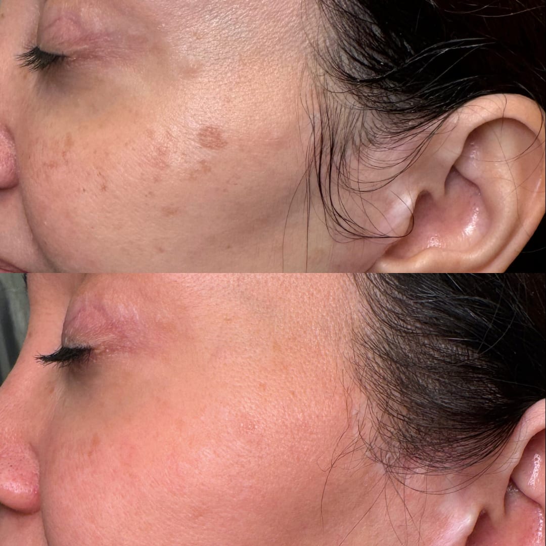 Lumecca IPL