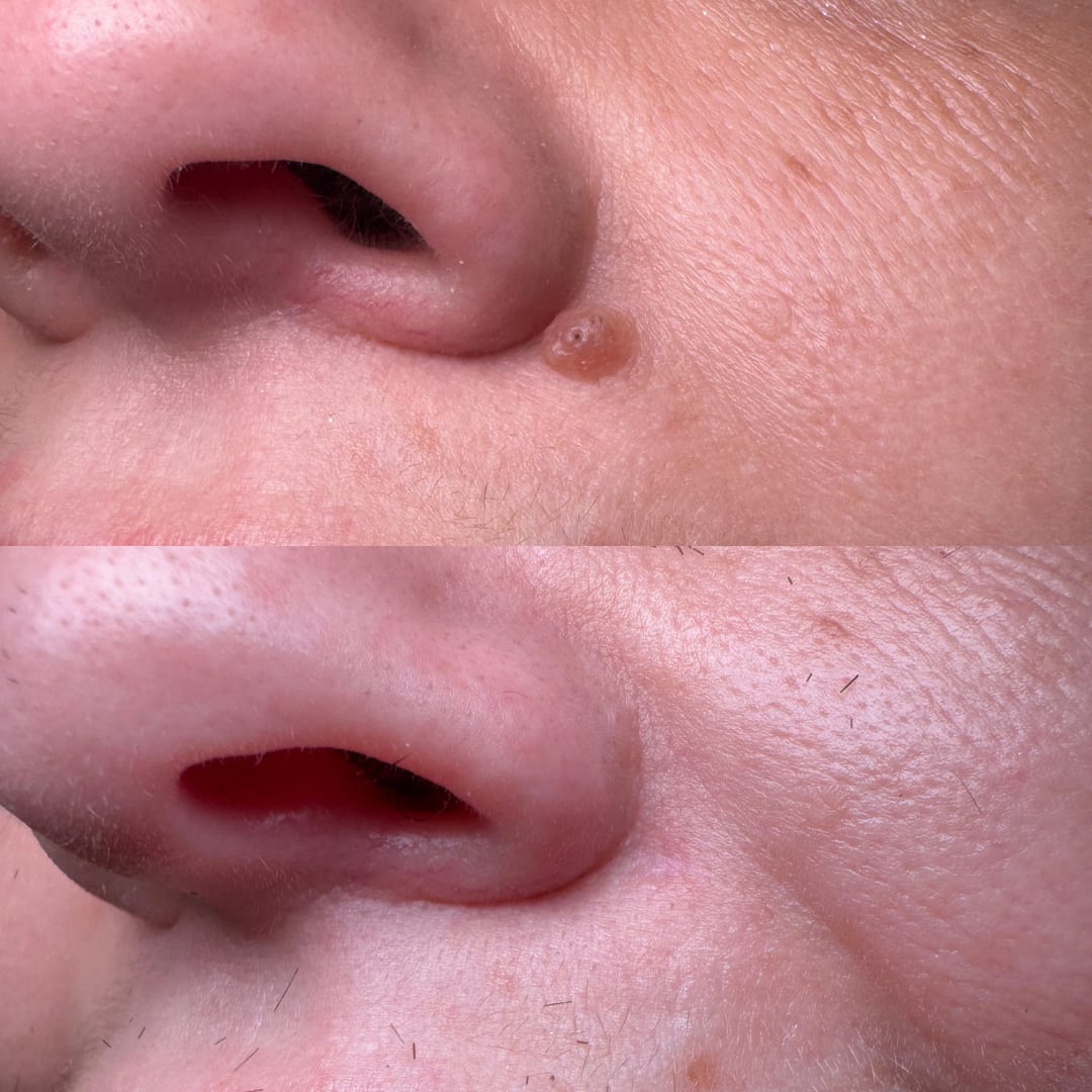 Mole Removal