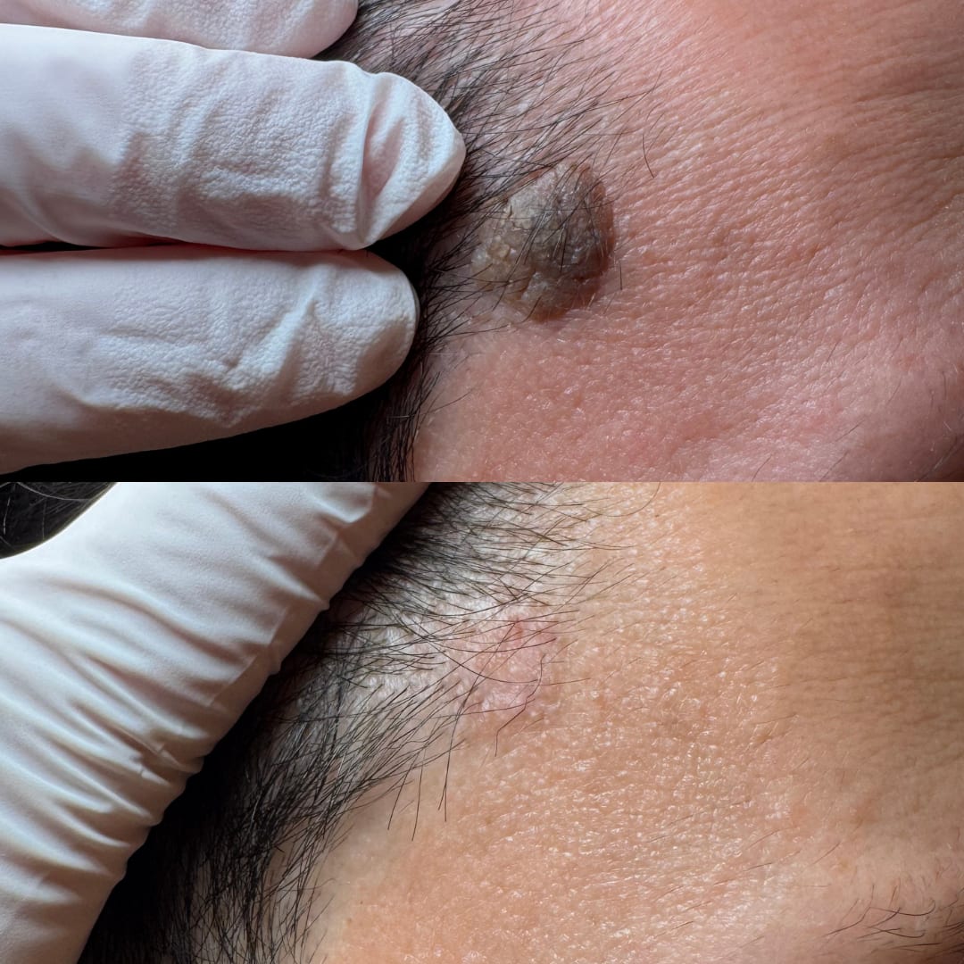Seborrhoeic Keratosis