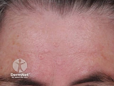 Sebaceous Hyperplasia