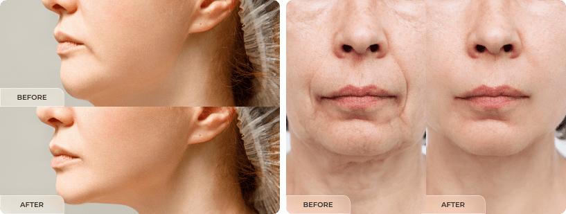 Collagen Stimulator