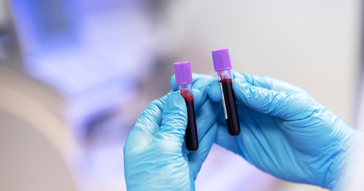 Desarrollan un test rápido y económico para detectar el cáncer de páncreas en sangre