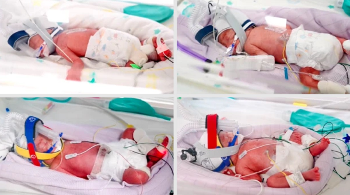 Nacimiento de cuatrillizas idénticas en Australia: un logro médico y familiar