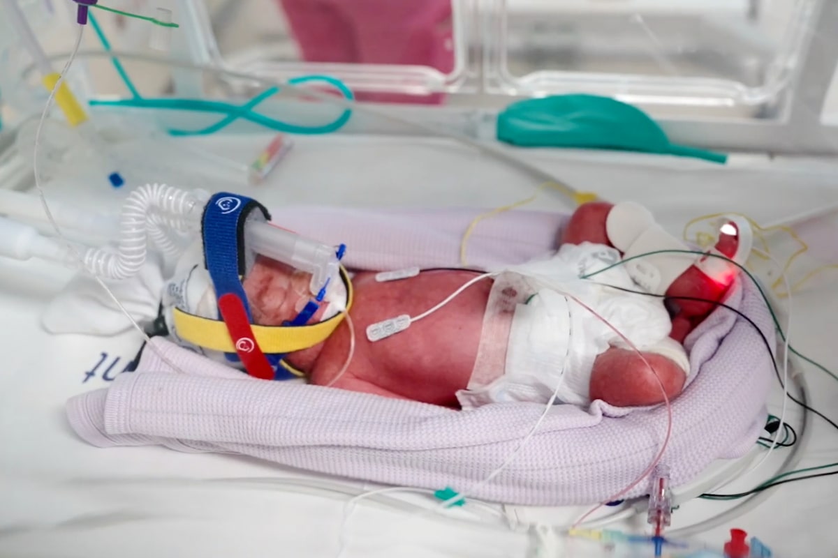 Rare natural conception of identical quadruplets celebrated in Australia