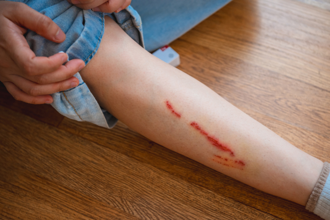 Vết thương chó cắn nhiễm trùng tiềm ẩn nhiều biến chứng nguy hiểm nếu không xử trí kịp thời. Ảnh minh họa: Vecteezy