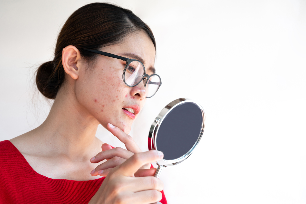 woman looking at adult acne in a mirror