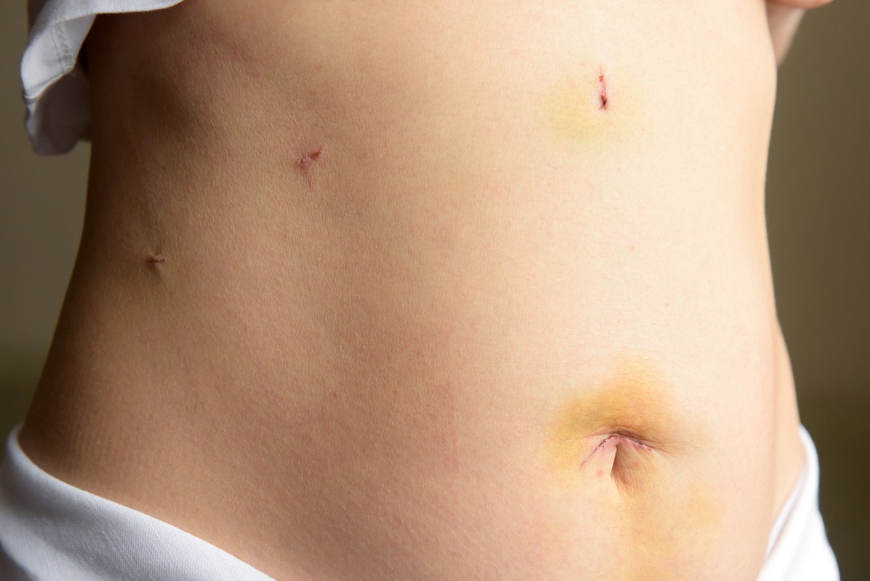 abdominal incisions from a laparoscopic surgery for endometriosis