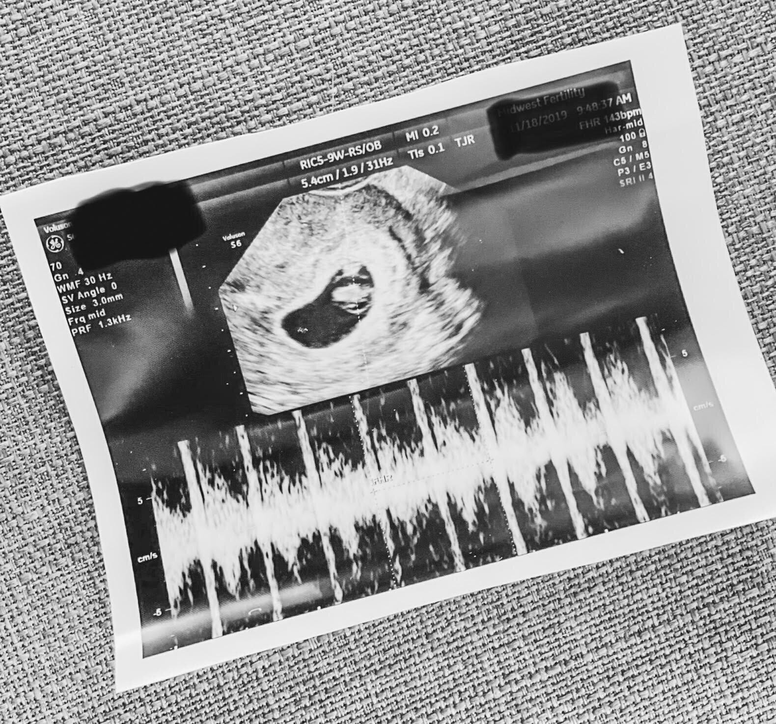 fetal ultrasound image