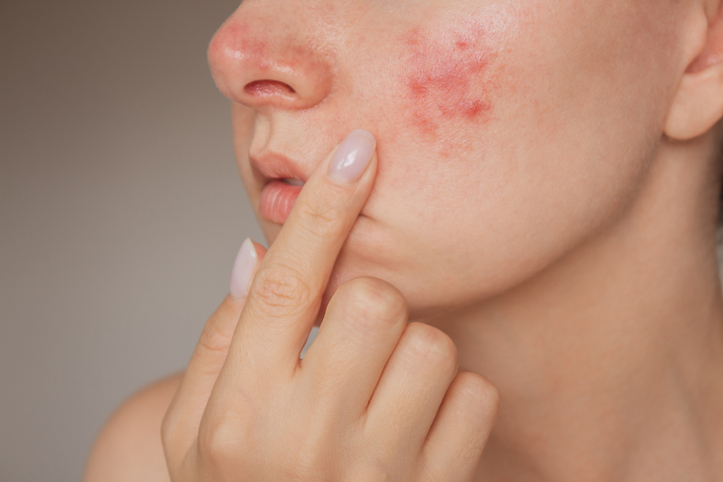 woman pointing to a patch of cystic acne on her face