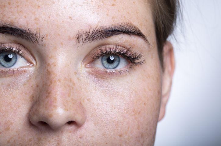 woman after a blepharoplasty