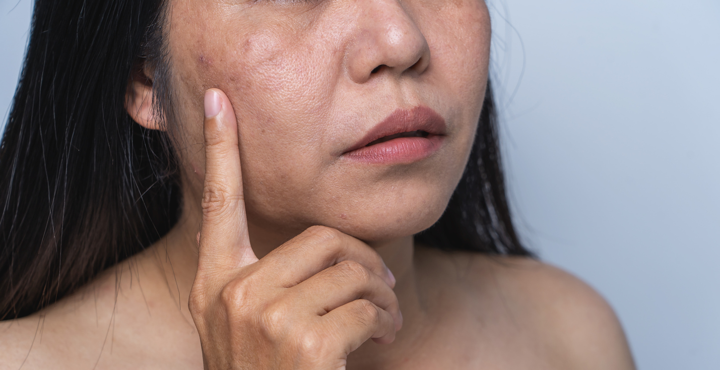 woman pointing to her perimenopausal acne lesions