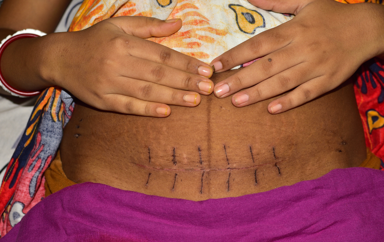 woman with c-section scar