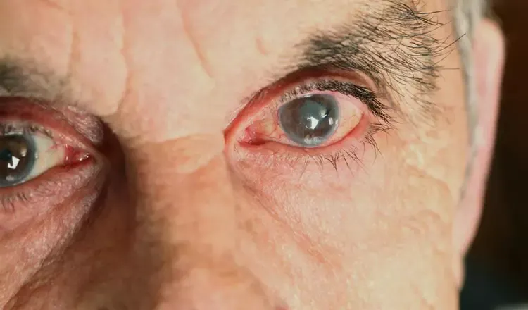 Como a cirurgia de catarata transforma a vida dos pacientes Como a cirurgia de catarata transforma a vida dos pacientes