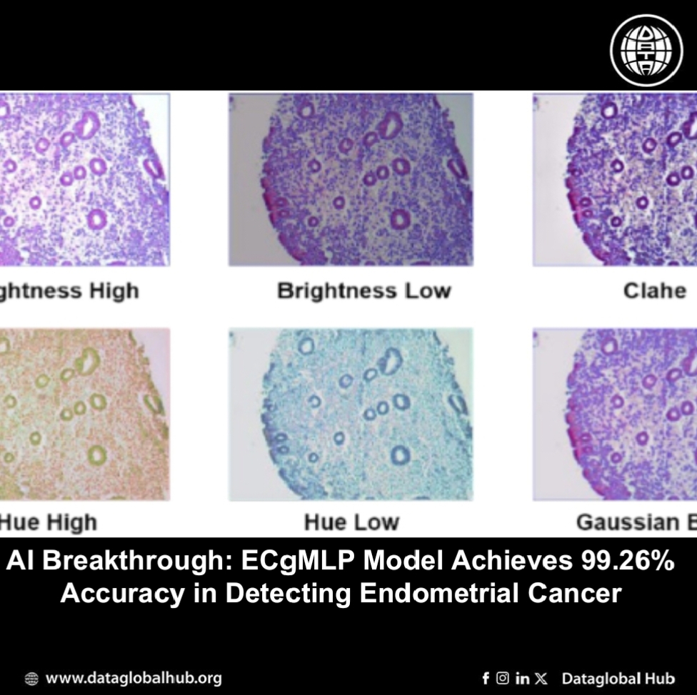 AI Breakthrough: ECgMLP Model Achieves 99.26% Accuracy in Detecting Endometrial Cancer. 