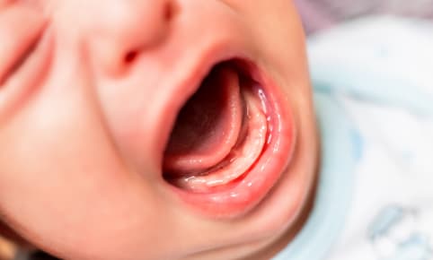 La poussée dentaire de bébé : les premiers maux de dents