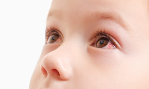 Affections de l'œil de bébé : la blépharite ou l'orgelet ?