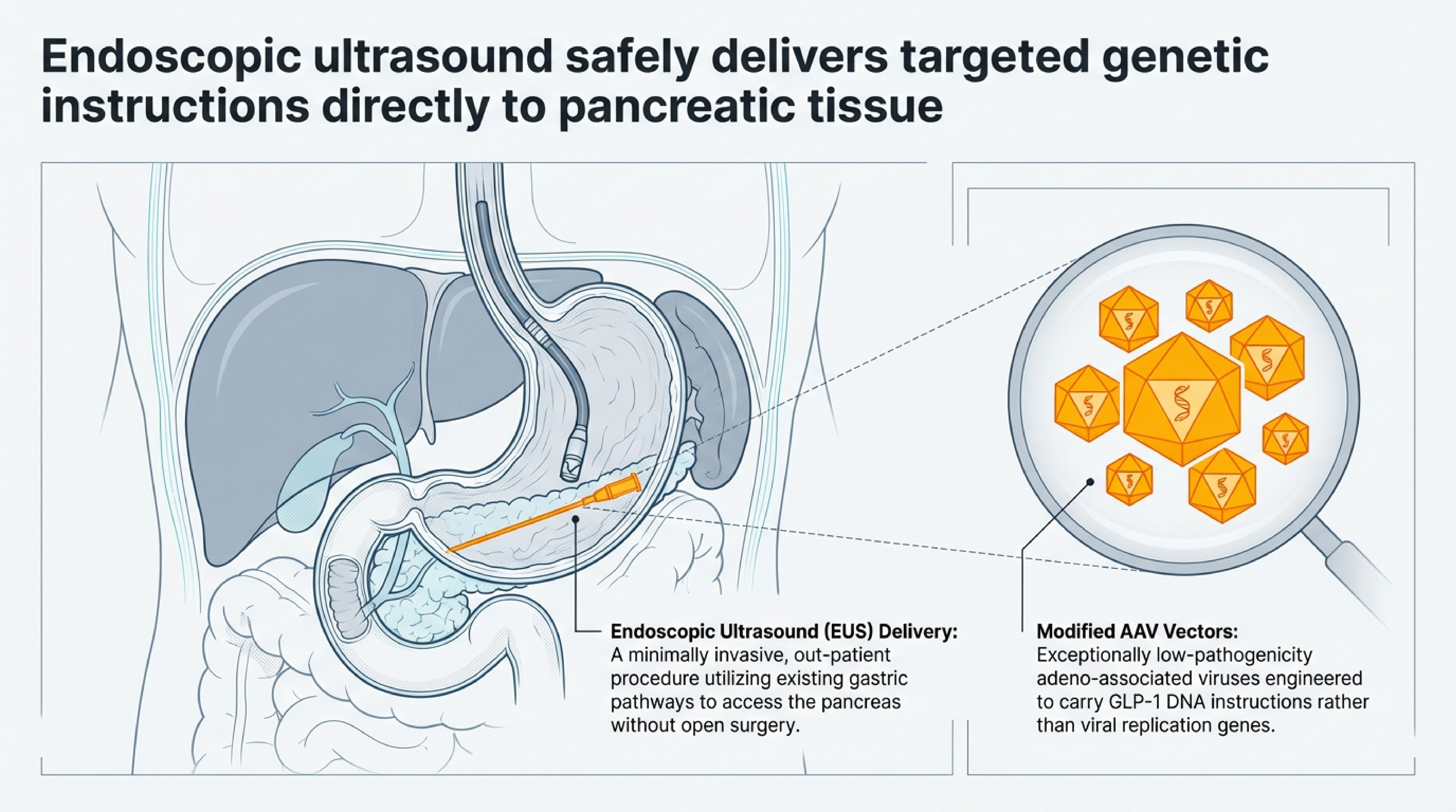Diagram of endoscopic ultrasound delivering modified AAV vectors to pancreatic tissue through a minimally invasive outpatient procedure