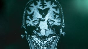 Alzheimer's disease prevention
