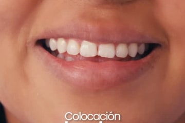 Colocación bordes de resina