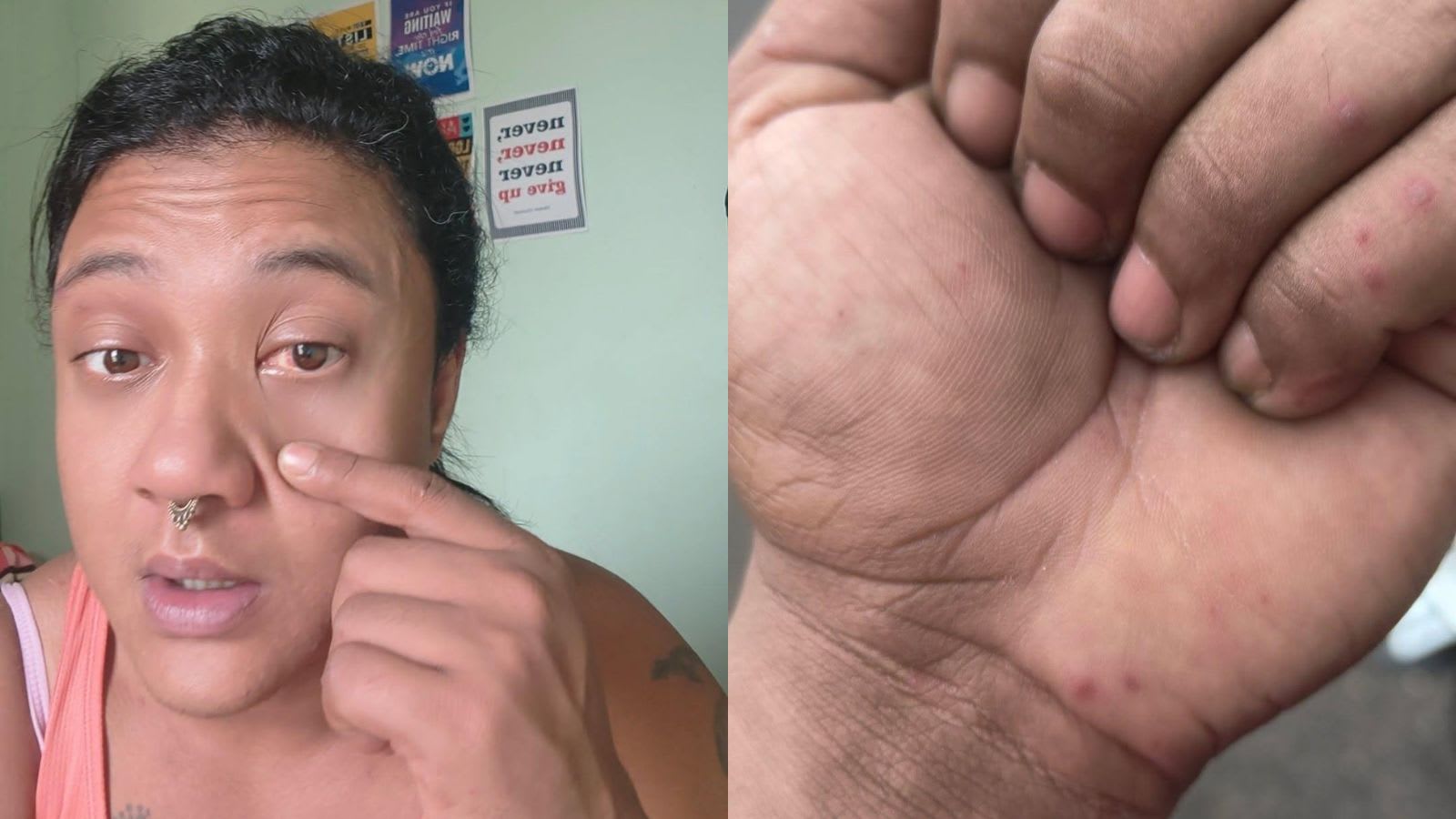 Wading through floodwater, Mumbai woman develops painful red bumps and fever: What is leptospirosis?