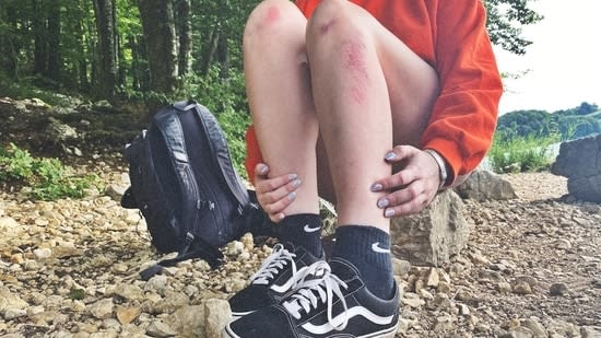 Did you know some people get itchy when they exercise? Dr Kunal Sood explains why that happens
