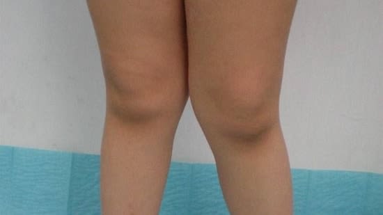 Did you know about knock knees in children? Dr Somesh Virmani shares causes, symptoms, and treatment