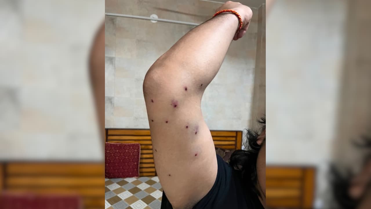"Saw Cop Pointing His Pellet Gun At Me": Man Injured In CJP Protest To NDTV