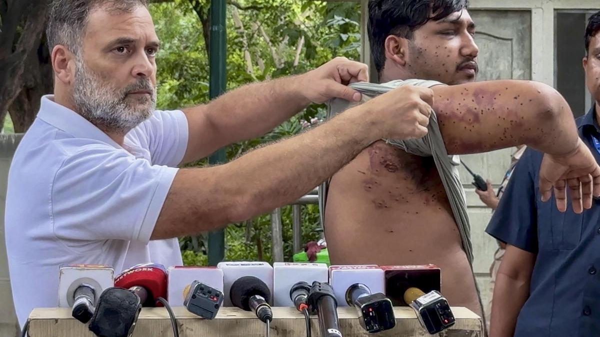Rahul shows pellet gun injuries of protester to slam Centre, says 'stop assaulting our students'