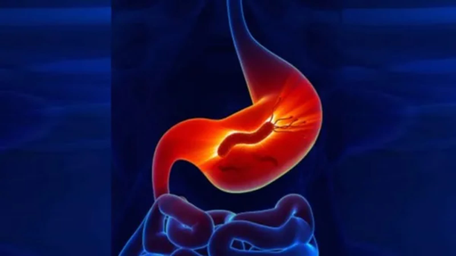 Two Mumbai women have rare stomach cancer that mimics ovarian tumour: What not to miss