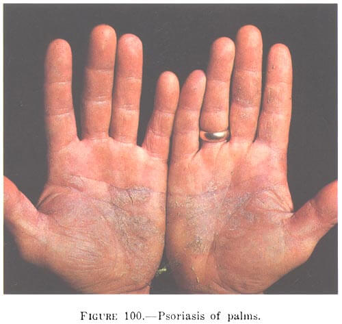 CBD for Psoriasis