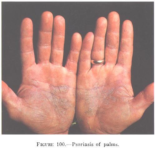 CBD for Psoriasis