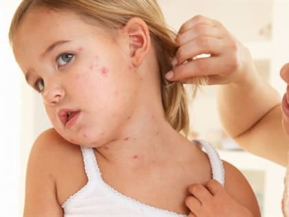 Переболеть не по-детски или Как ульяновцам спастись от кори и гриппа