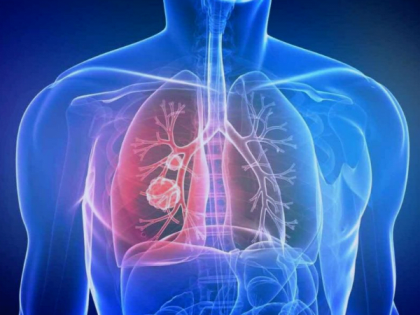 Ежегодно у 500 жителей Ульяновской области выявляют  новообразования в легких