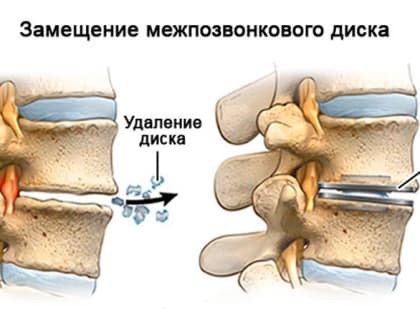 А вместо диска - подвижное ядро. Как ульяновцам спастись от болей в спине