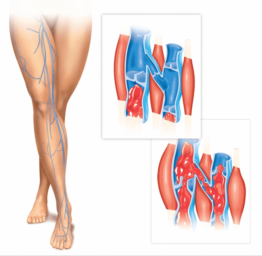 Тромбофлебит варикозных вен. Тромб подколенной вены. Варикоз расширение вен нижних конечностей. Варикозное расширение вен голени. Варикозное расширение вен нижних конечностей, тромбофлебит.
