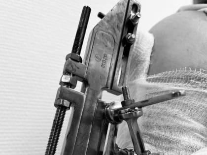 Шестнадцатилетнюю девушку прооперировали травматологи в Подмосковье