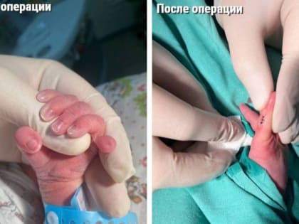Подмосковные врачи успешно провели операцию по удалению шестого пальца у младенца