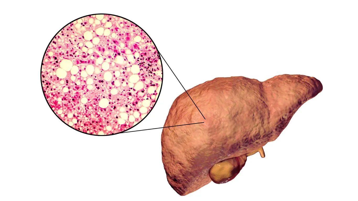 الكبد الدهني بين نمط الحياة والتدخل الطبي